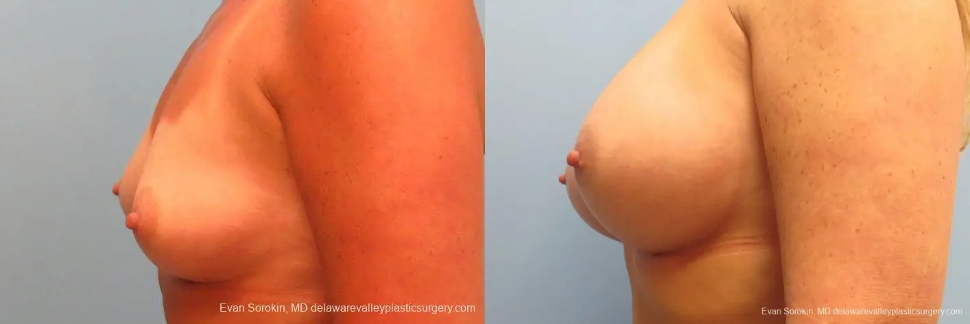 Philadelphia Breast Augmentation 9406 - Before and After 5