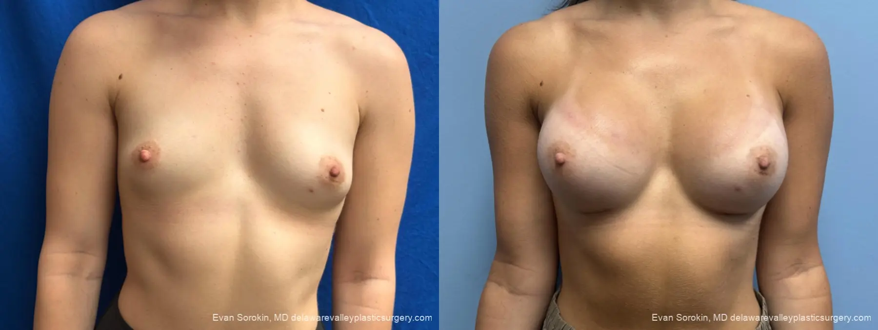 Breast Augmentation: Patient 3 - Before and After