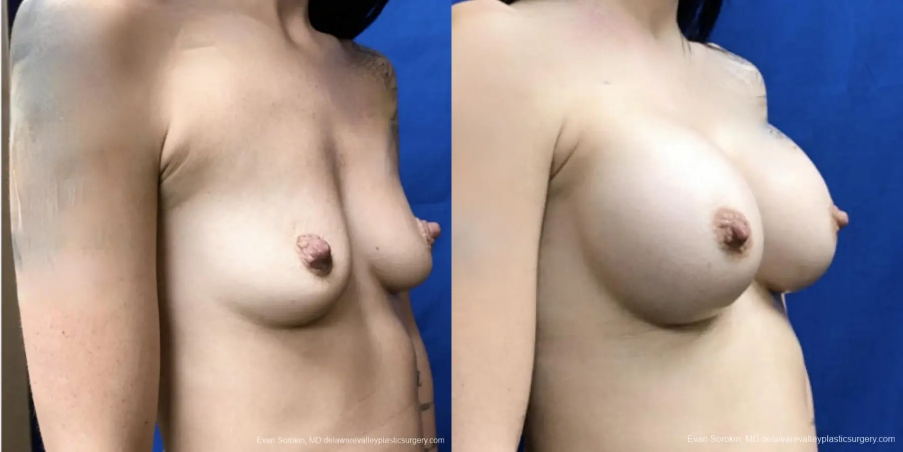 Breast Augmentation: Patient 162 - Before and After 2