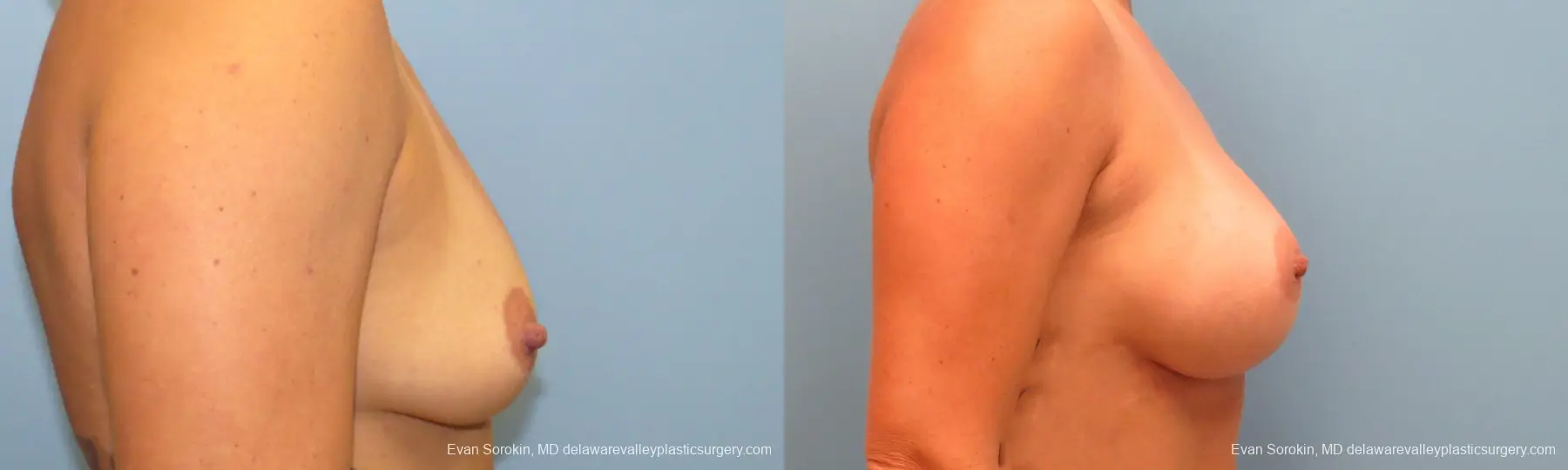 Philadelphia Breast Augmentation 9388 - Before and After 3