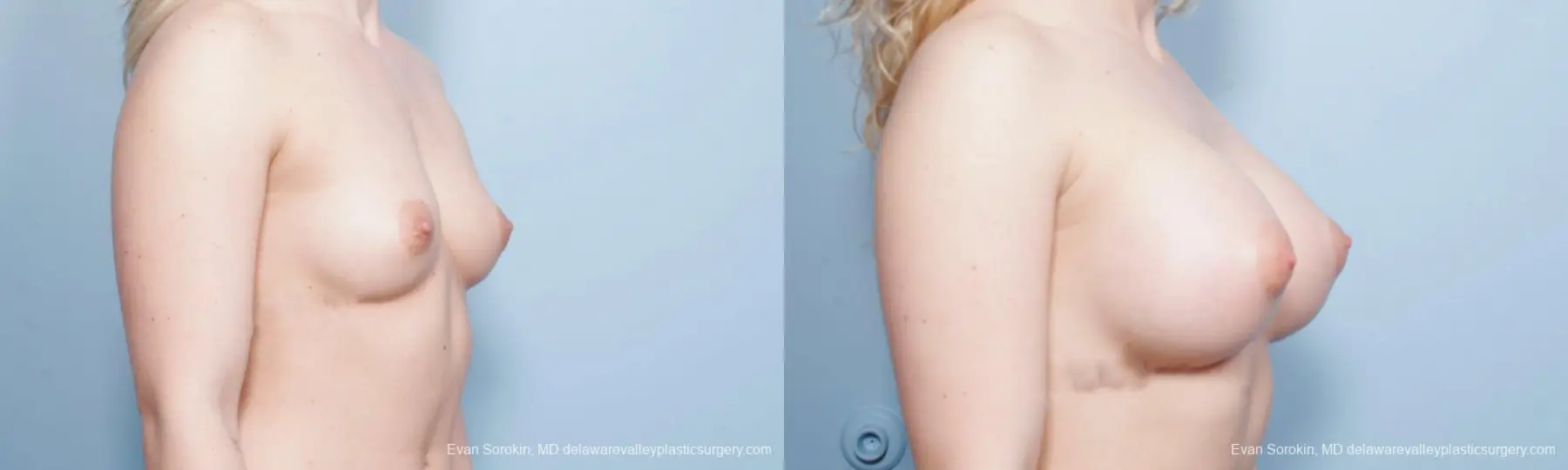 Breast Augmentation: Patient 130 - Before and After 2