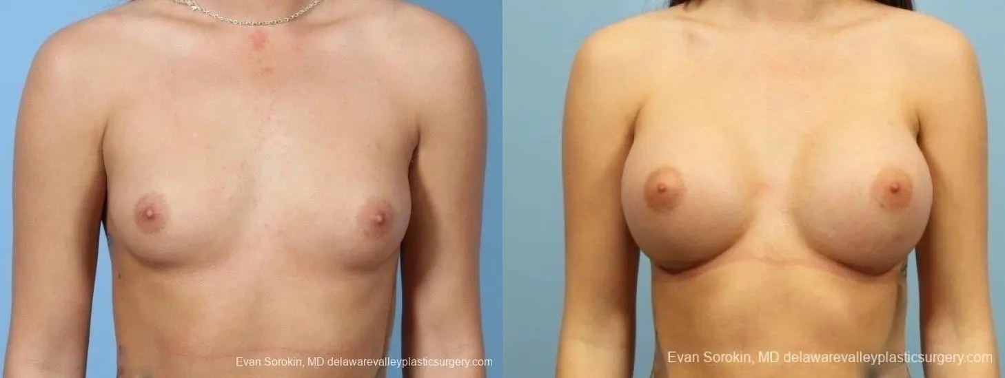 Philadelphia Breast Augmentation 8657 - Before and After 1