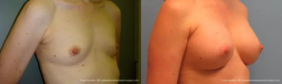 Philadelphia Breast Augmentation 9180 - Before and After 2