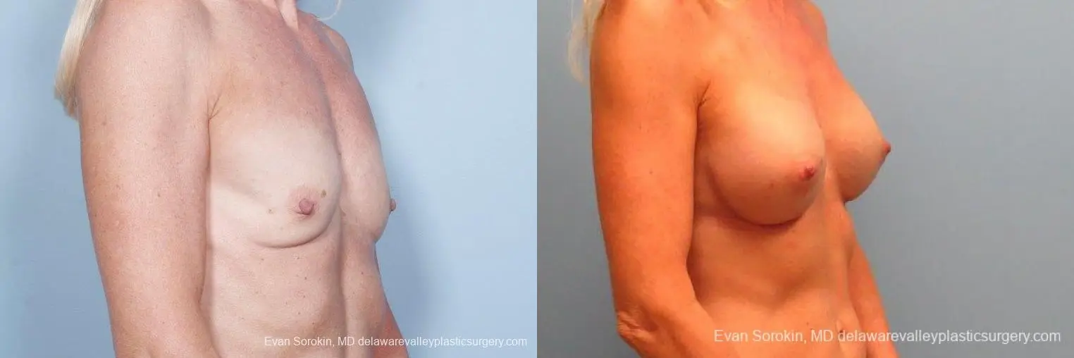 Philadelphia Breast Augmentation 9415 - Before and After 2