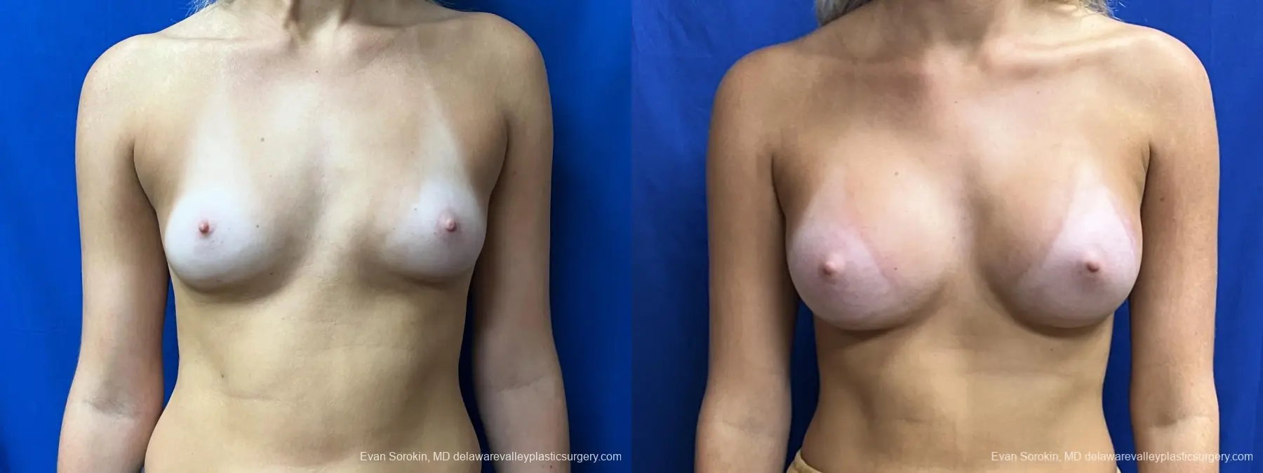 Breast Augmentation: Patient 254 - Before and After 1