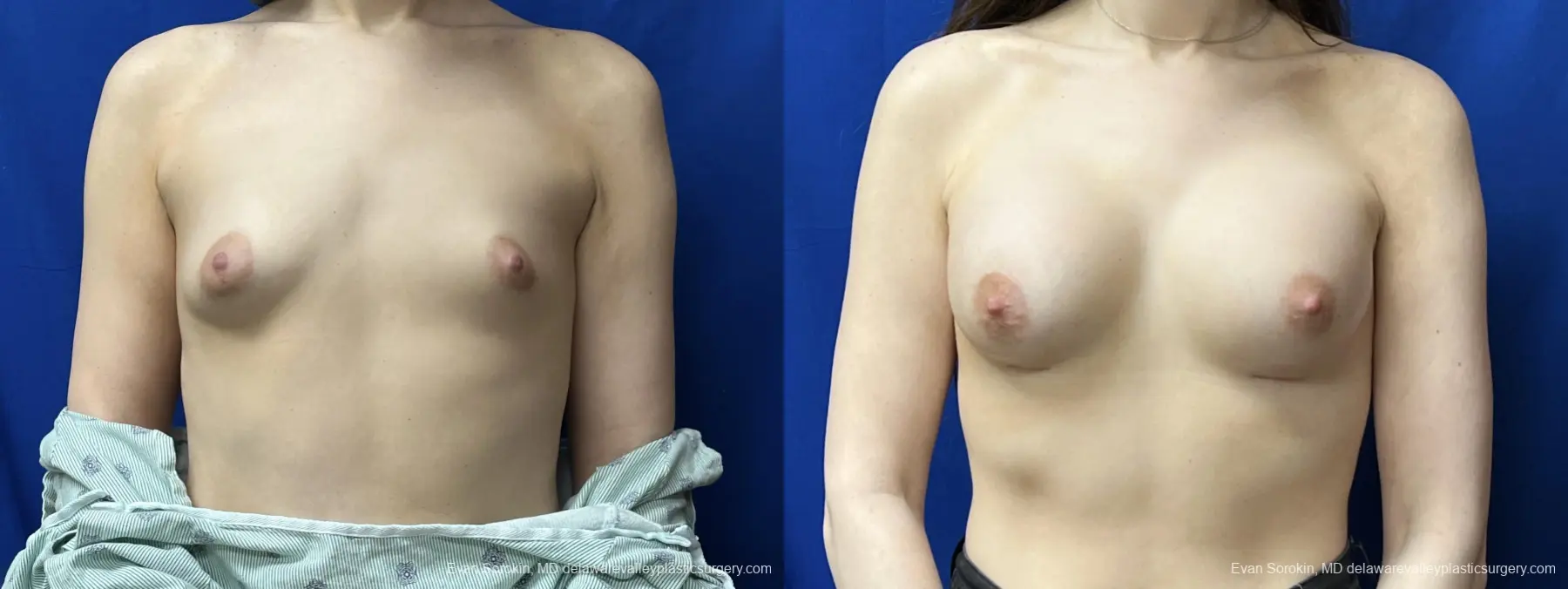 Breast Augmentation: Patient 239 - Before and After 1