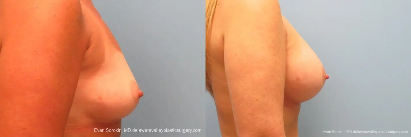 Philadelphia Breast Augmentation 9406 - Before and After 3