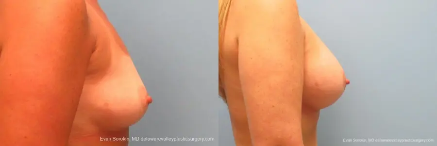 Philadelphia Breast Augmentation 9406 - Before and After 3