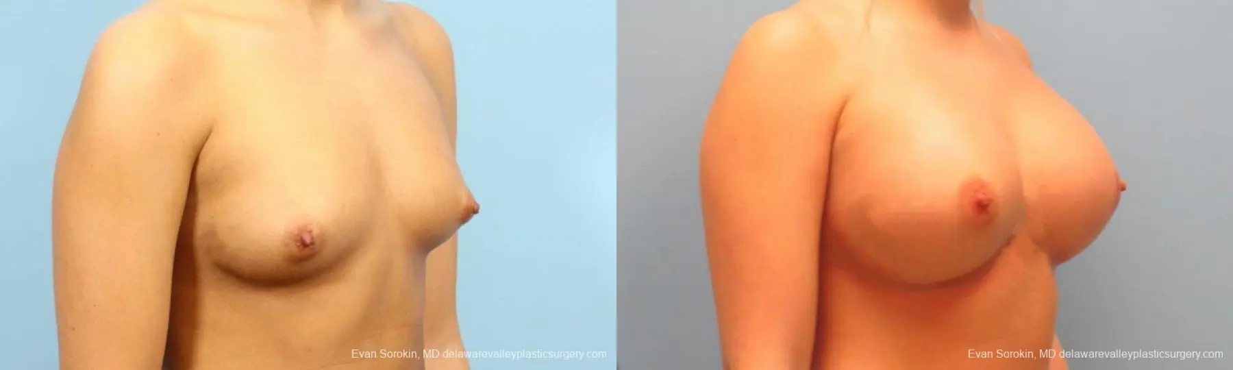Philadelphia Breast Augmentation 9393 - Before and After 2