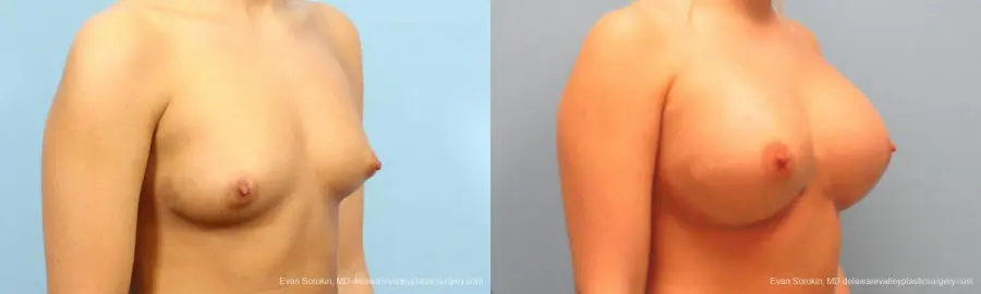 Philadelphia Breast Augmentation 9393 - Before and After 2