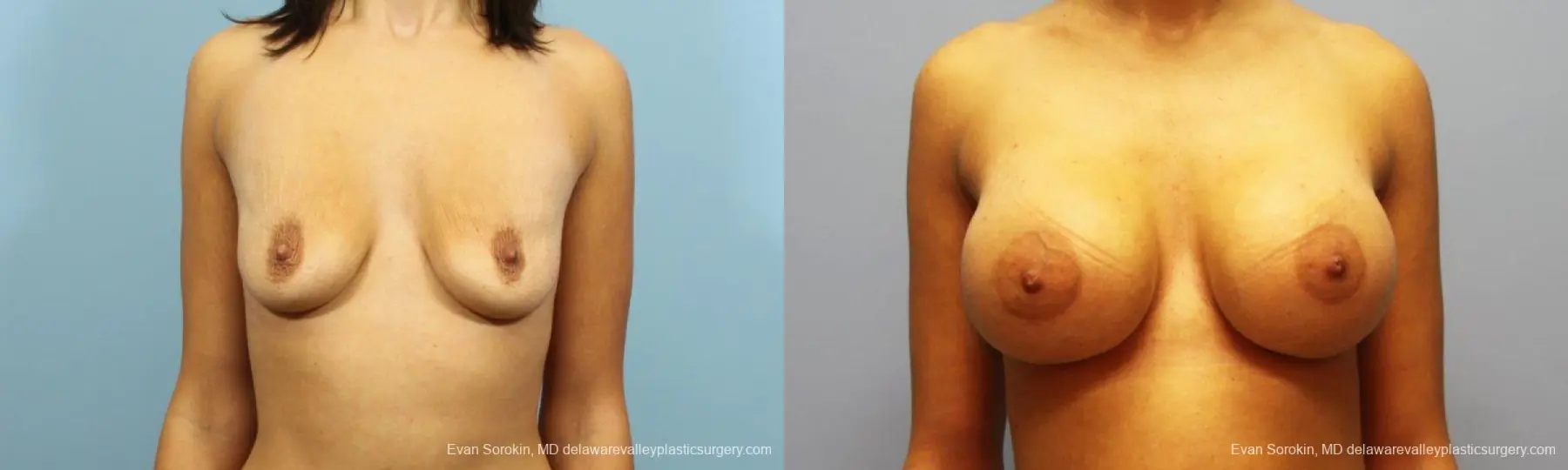 Philadelphia Breast Augmentation 9205 - Before and After 1