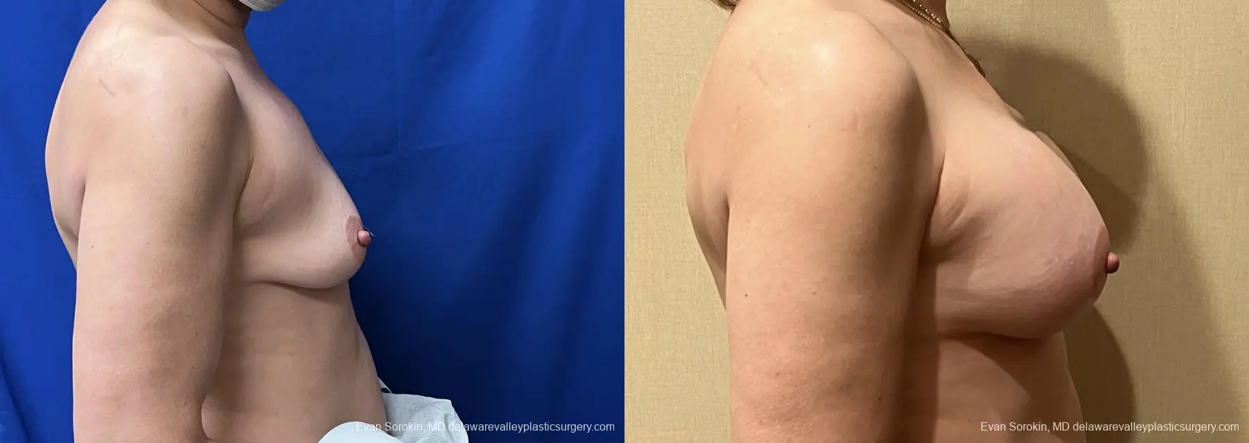 Breast Augmentation: Patient 215 - Before and After 3