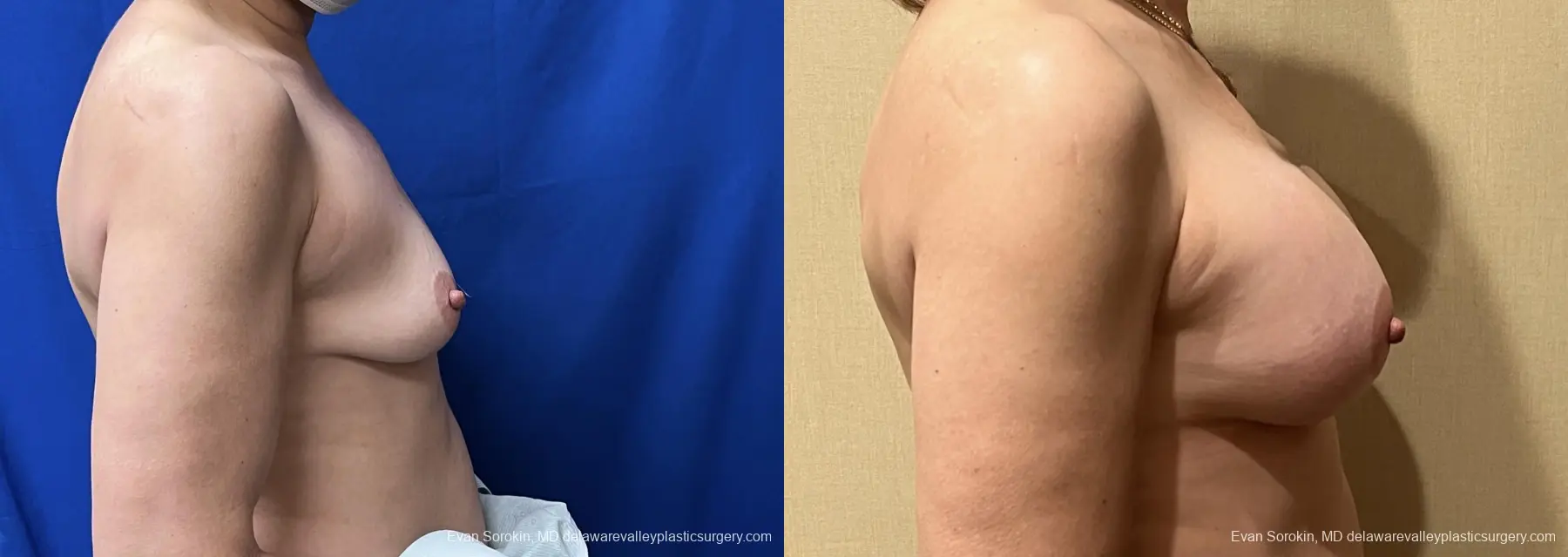 Breast Augmentation: Patient 255 - Before and After 3