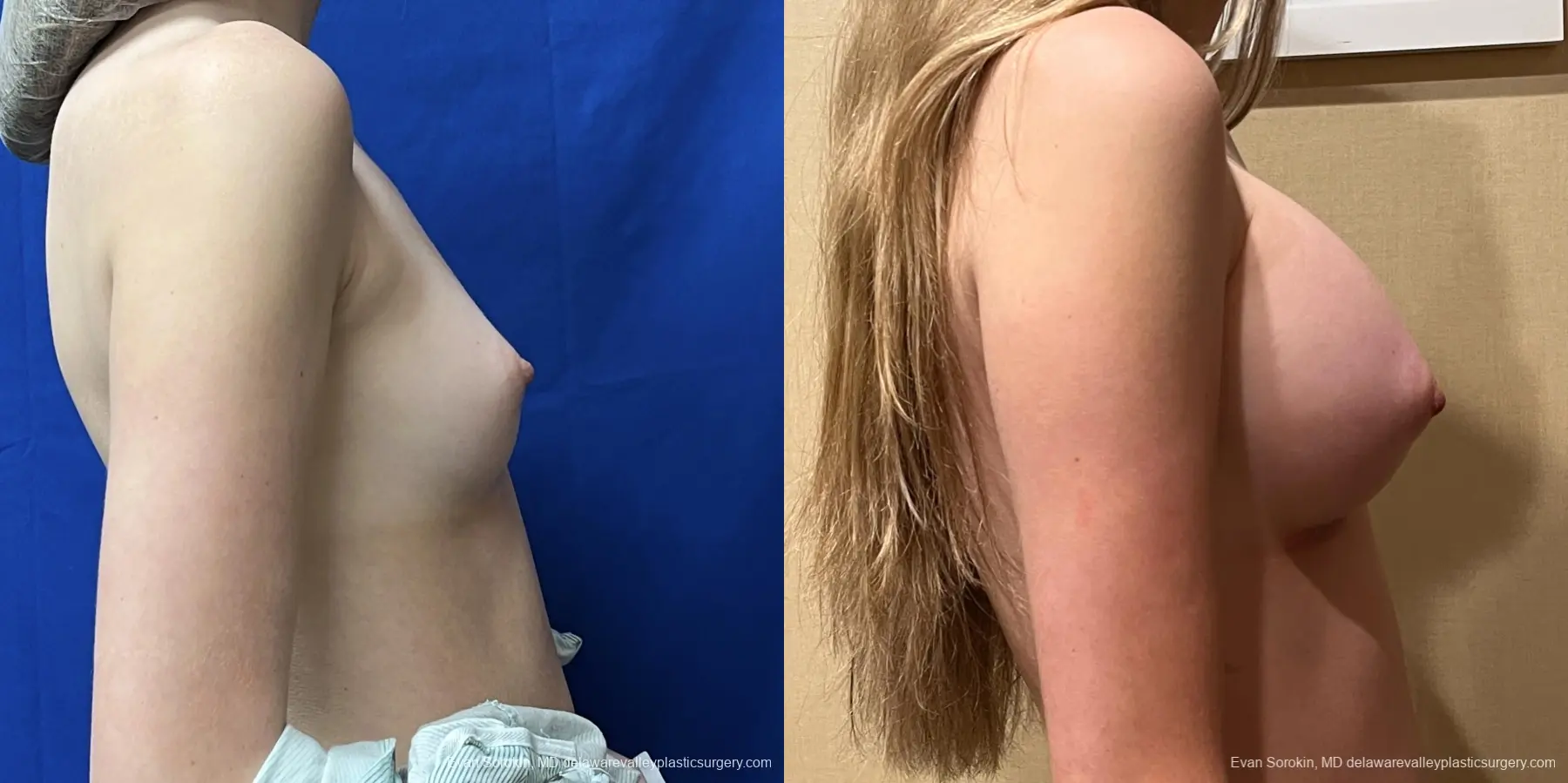 Breast Augmentation: Patient 246 - Before and After 3