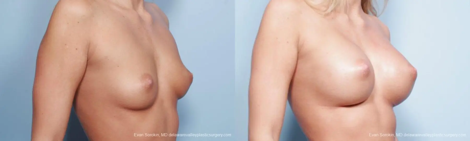 Philadelphia Breast Augmentation 9177 - Before and After 4