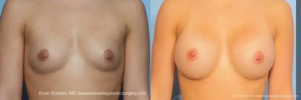 Philadelphia Breast Augmentation 8773 - Before and After 1