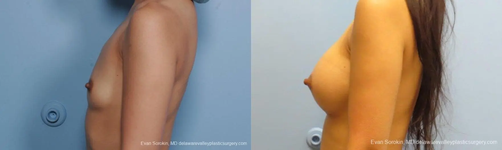Philadelphia Breast Augmentation 8661 - Before and After 5