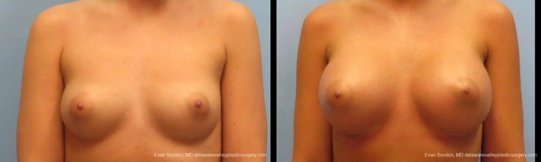Breast Augmentation: Patient 12 - Before and After 1