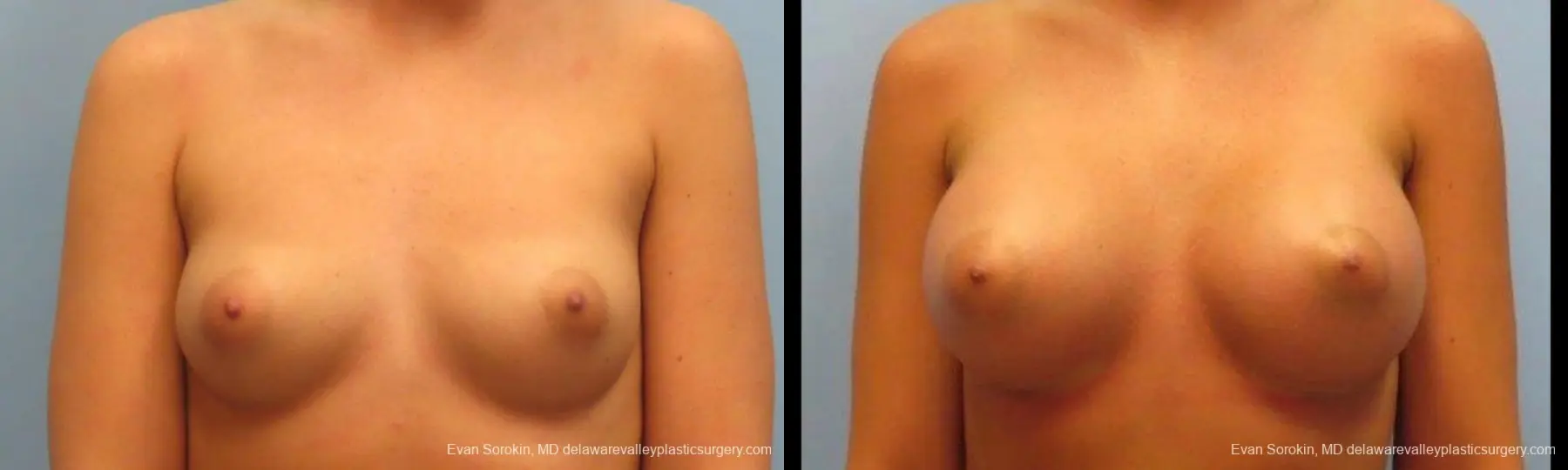 Breast Augmentation: Patient 12 - Before and After  