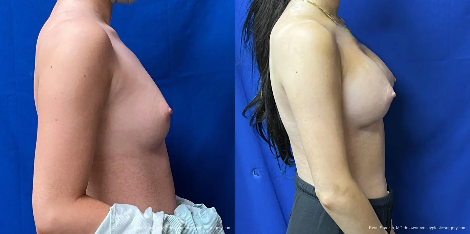 Breast Augmentation: Patient 215 - Before and After 3