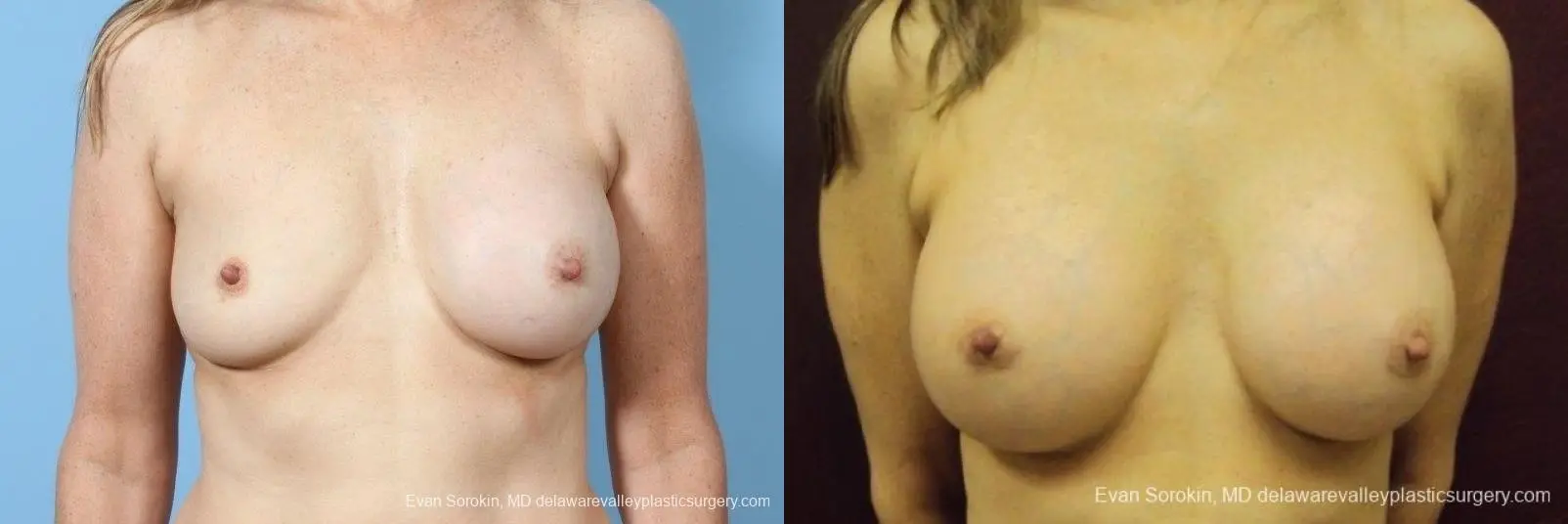 Philadelphia Breast Augmentation 8708 - Before and After 1