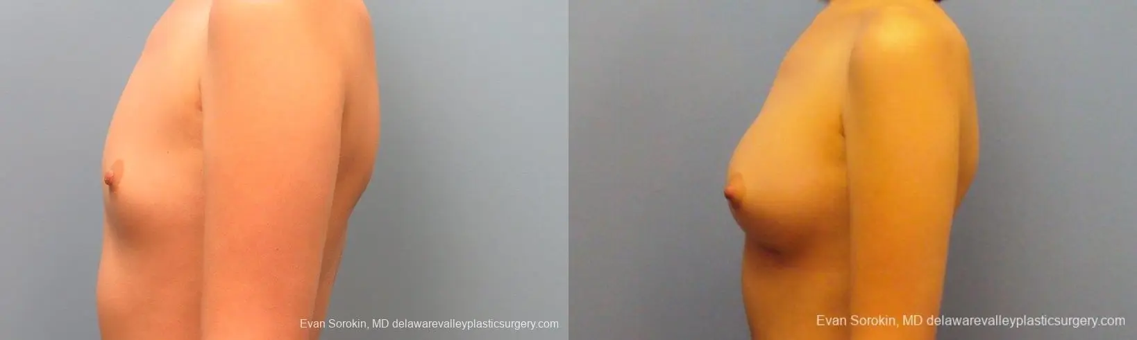 Philadelphia Breast Augmentation 10113 - Before and After 5