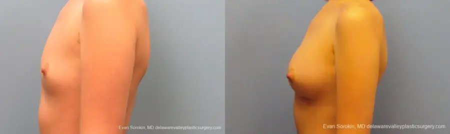 Philadelphia Breast Augmentation 10113 - Before and After 5