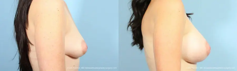 Philadelphia Breast Augmentation 9346 - Before and After 3