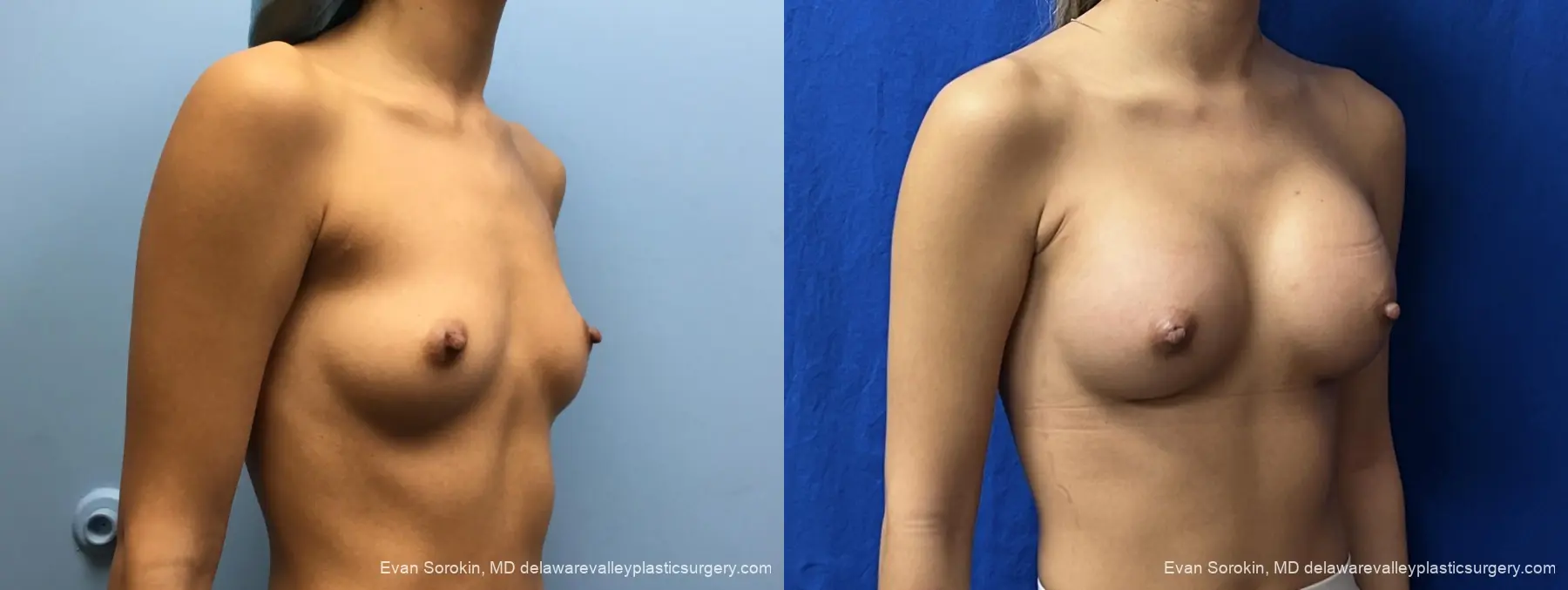 Breast Augmentation: Patient 327 - Before and After 2