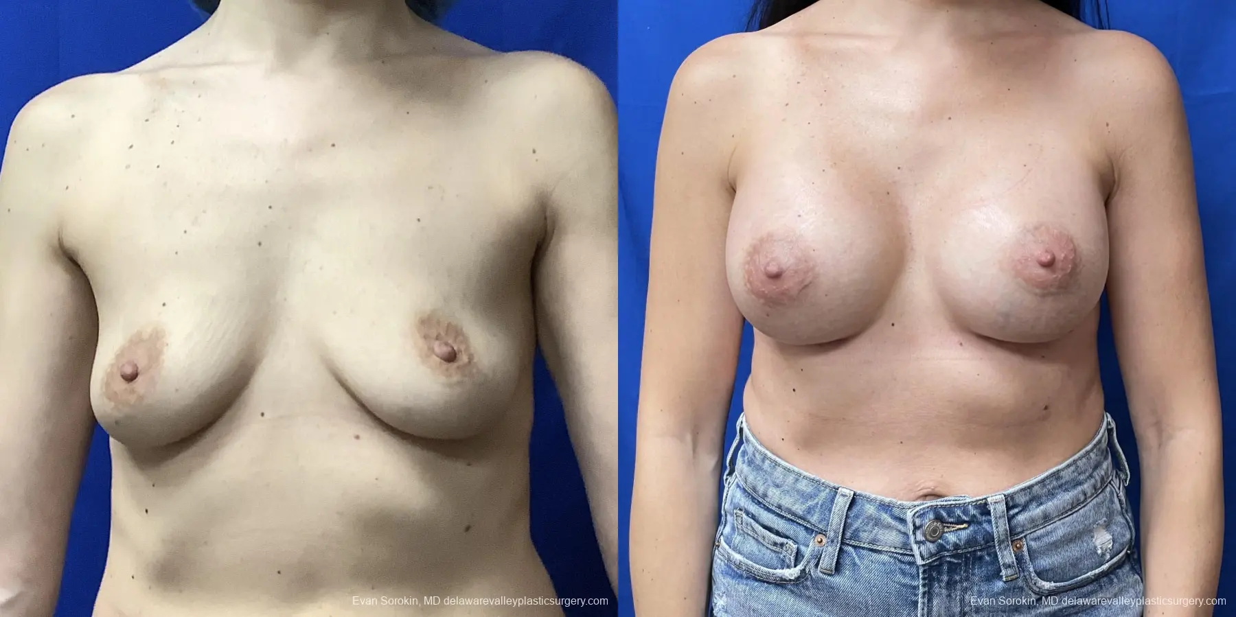 Breast Augmentation: Patient 173 - Before and After 1