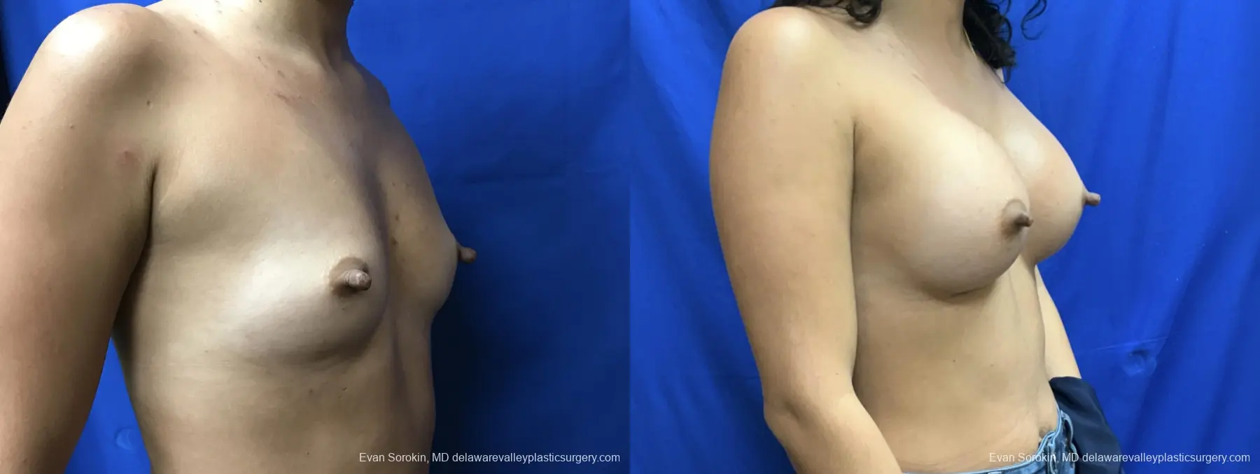 Breast Augmentation: Patient 210 - Before and After 2