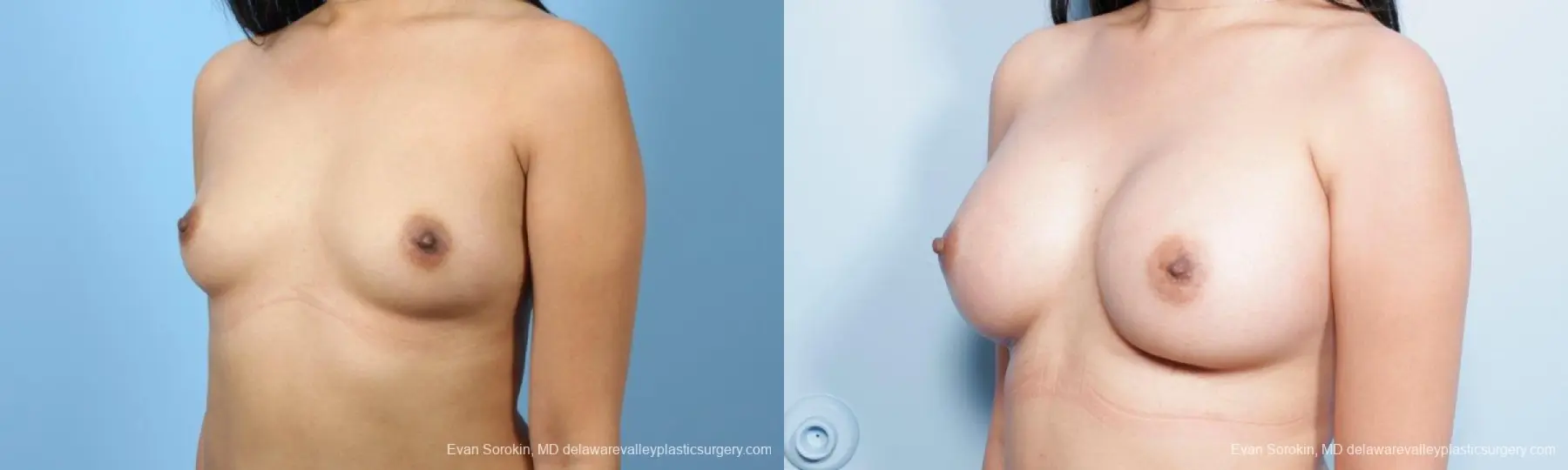 Philadelphia Breast Augmentation 9298 - Before and After 4