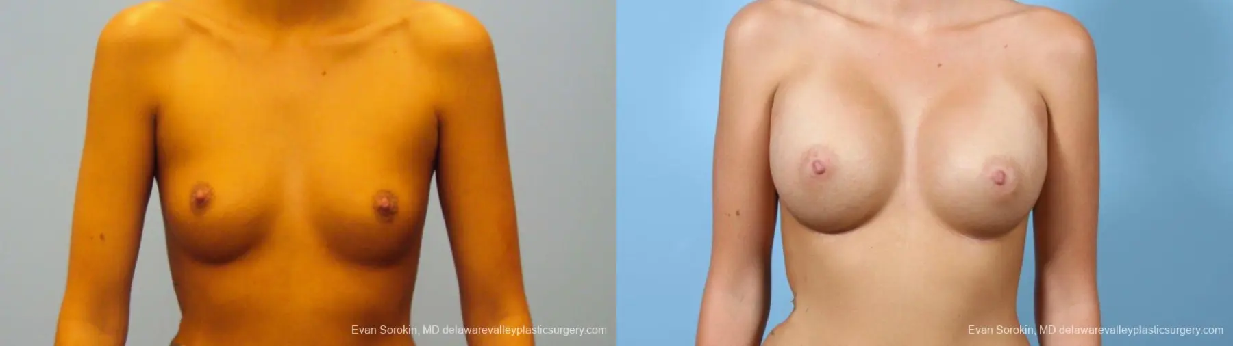 Philadelphia Breast Augmentation 9292 - Before and After 1