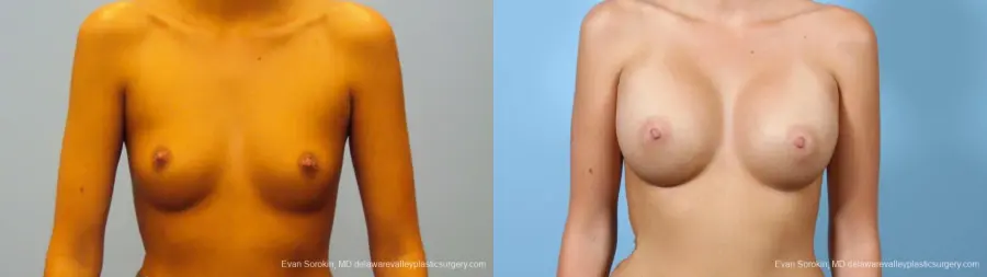 Philadelphia Breast Augmentation 9292 - Before and After 1