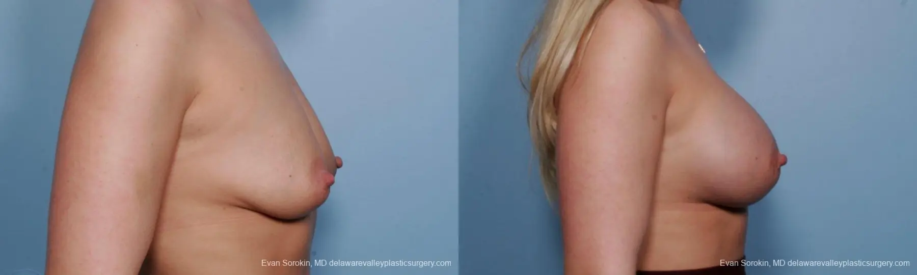 Philadelphia Breast Augmentation 9372 - Before and After 3