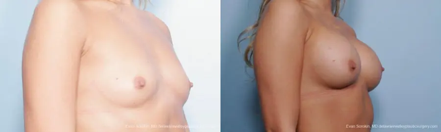 Philadelphia Breast Augmentation 9356 - Before and After 2