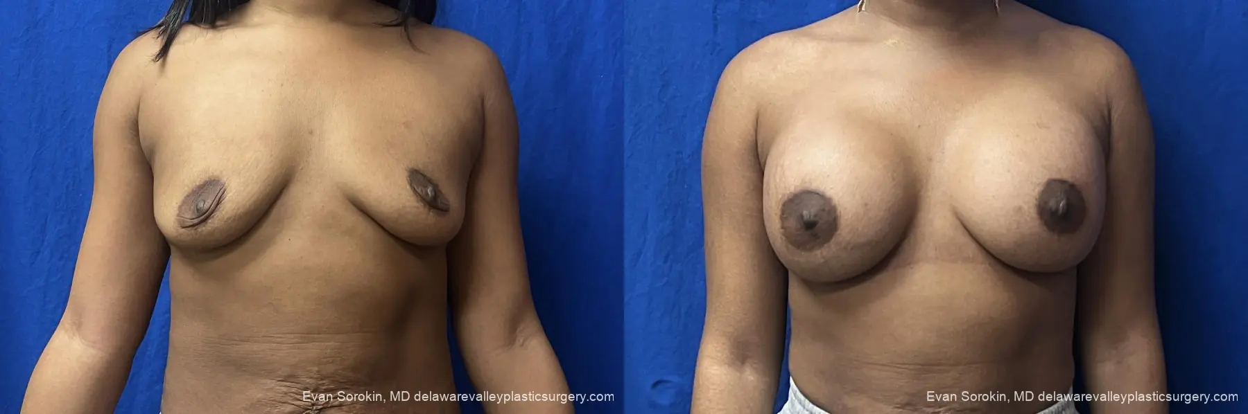 Breast Augmentation: Patient 271 - Before and After 1