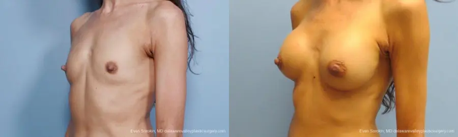 Philadelphia Breast Augmentation 9424 - Before and After 4