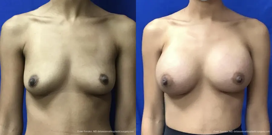 Breast Augmentation: Patient 191 - Before and After 1