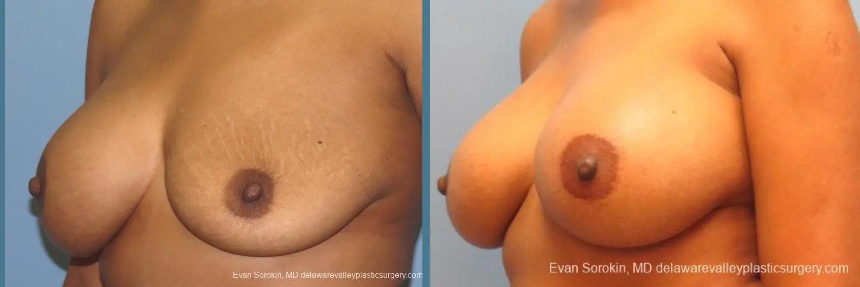 Philadelphia Breast Augmentation 10112 - Before and After 2