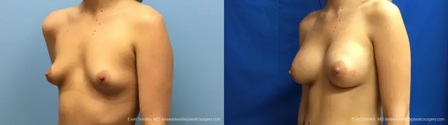 Philadelphia Breast Augmentation 12540 - Before and After 3