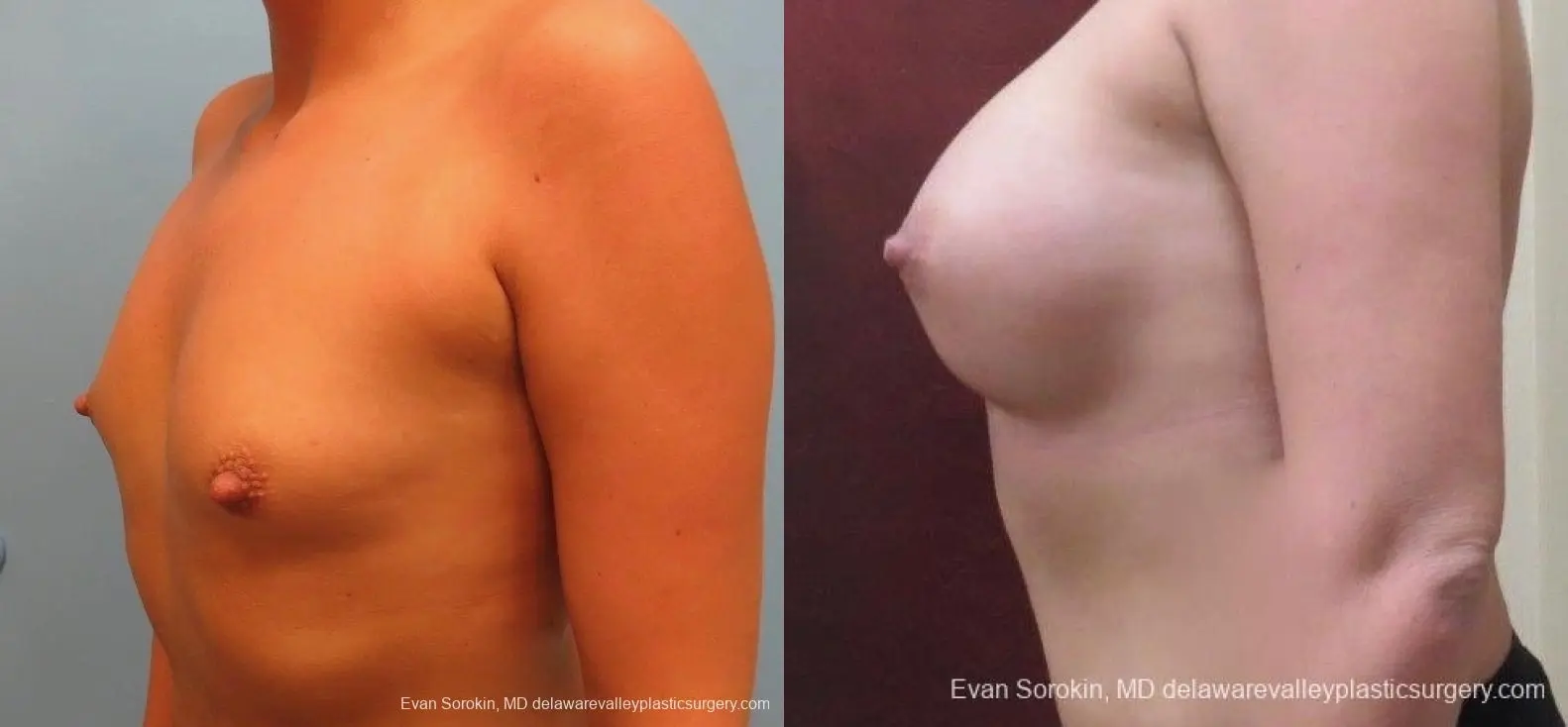 Philadelphia Breast Augmentation 8826 - Before and After 5