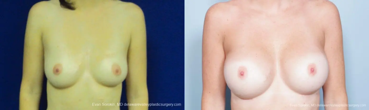 Philadelphia Breast Augmentation 8777 - Before and After 1