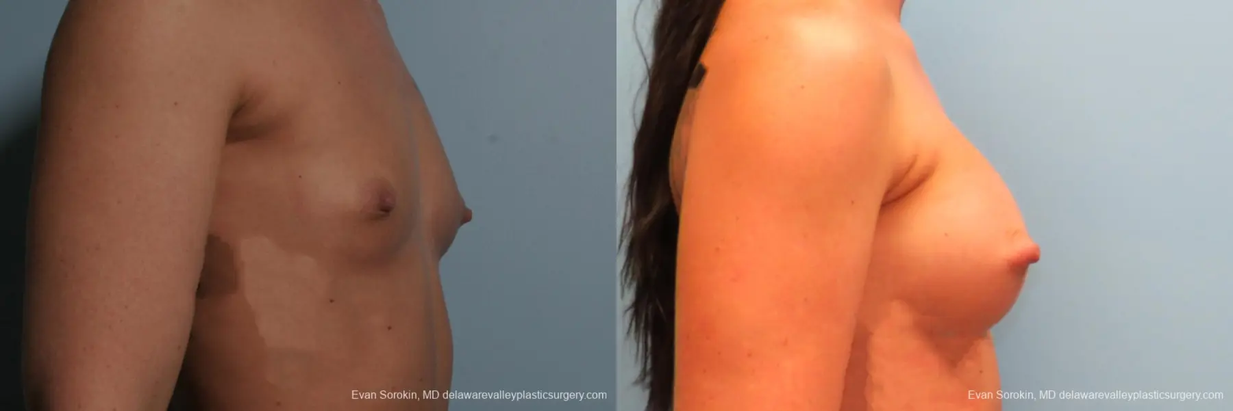 Philadelphia Breast Augmentation 8664 - Before and After 3