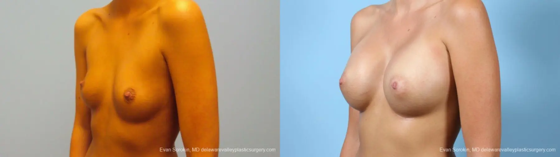 Philadelphia Breast Augmentation 9292 - Before and After 3