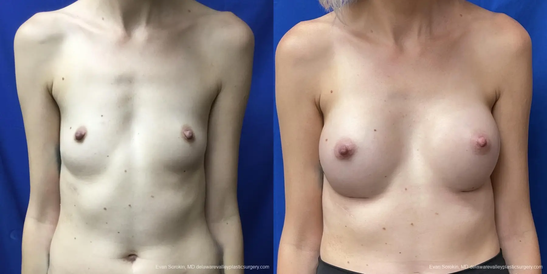 Breast Augmentation: Patient 174 - Before and After 1