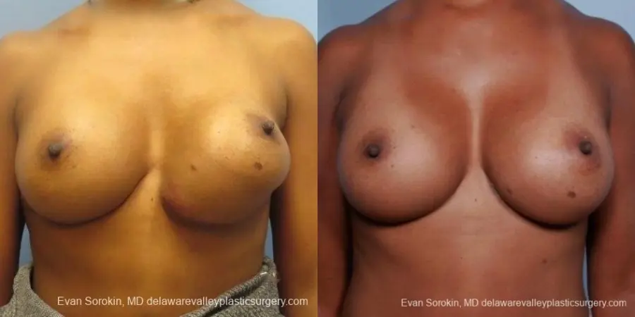Philadelphia Breast Augmentation 8653 - Before and After