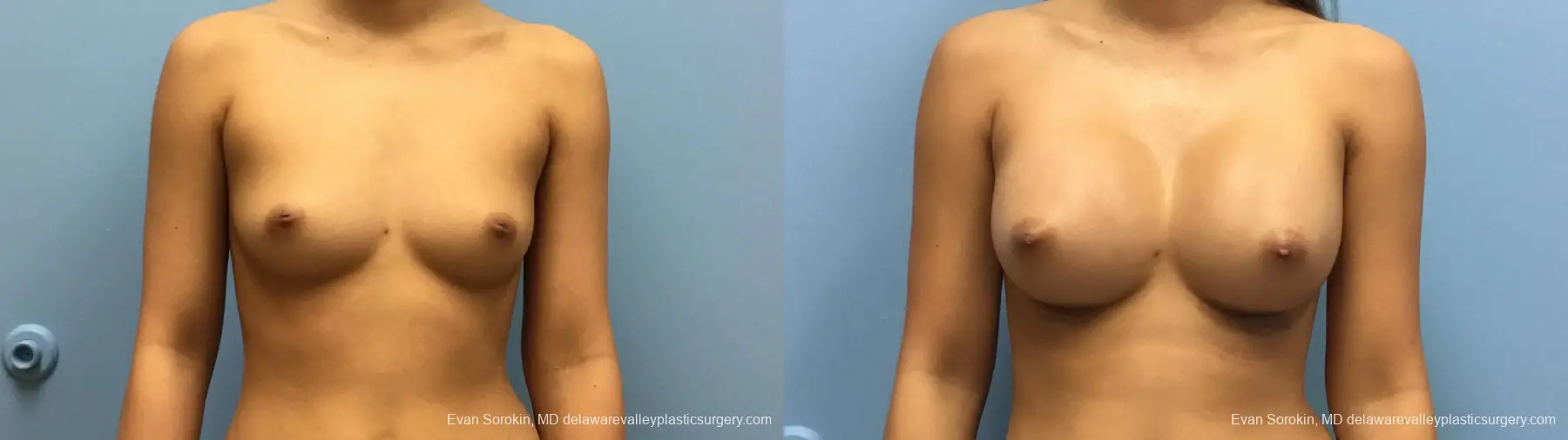 Philadelphia Breast Augmentation 13183 - Before and After 1
