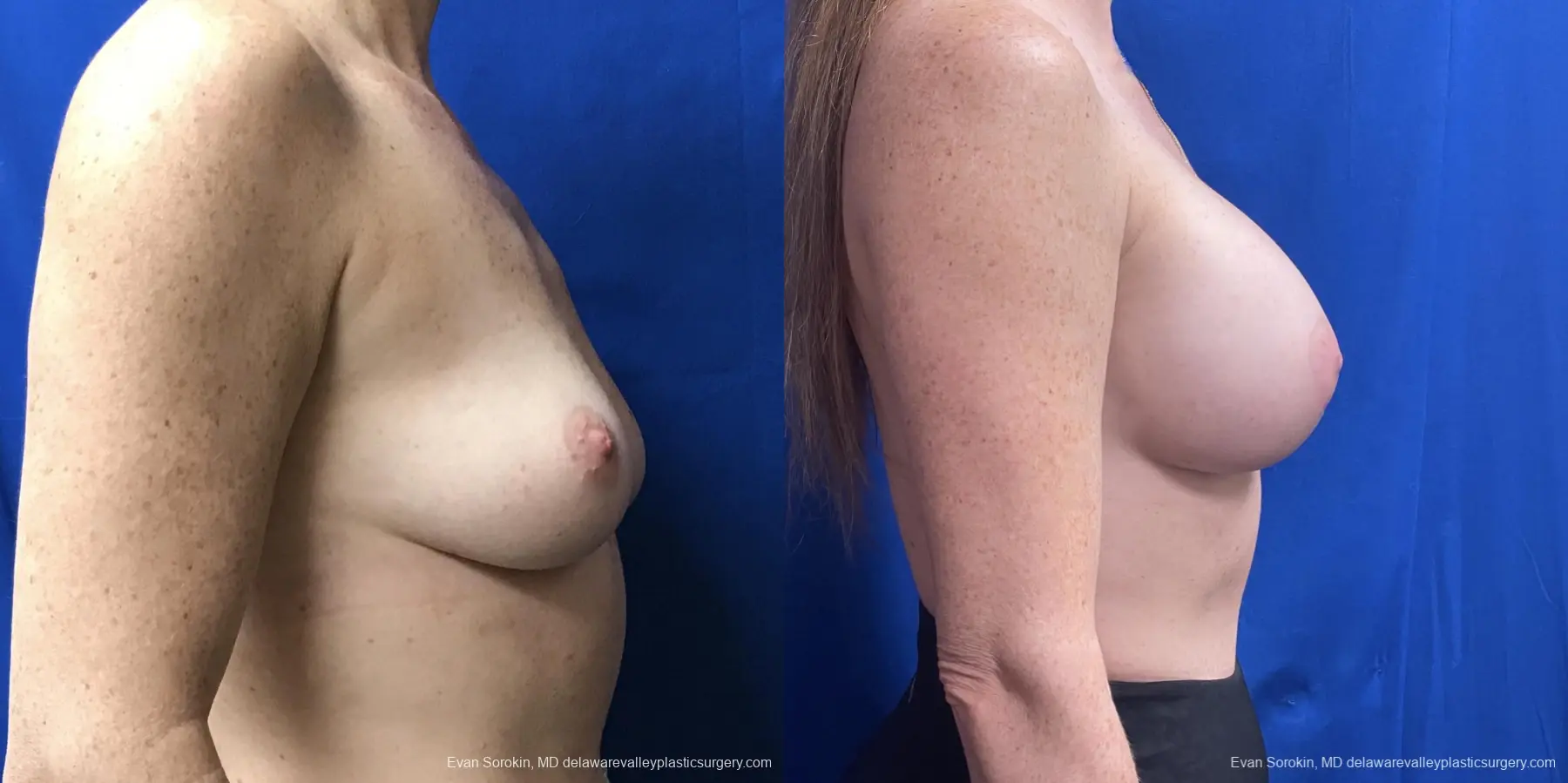 Breast Augmentation: Patient 235 - Before and After 3