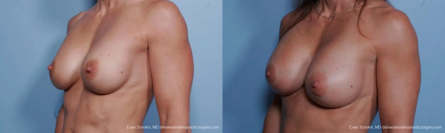 Philadelphia Breast Augmentation 9455 - Before and After 4